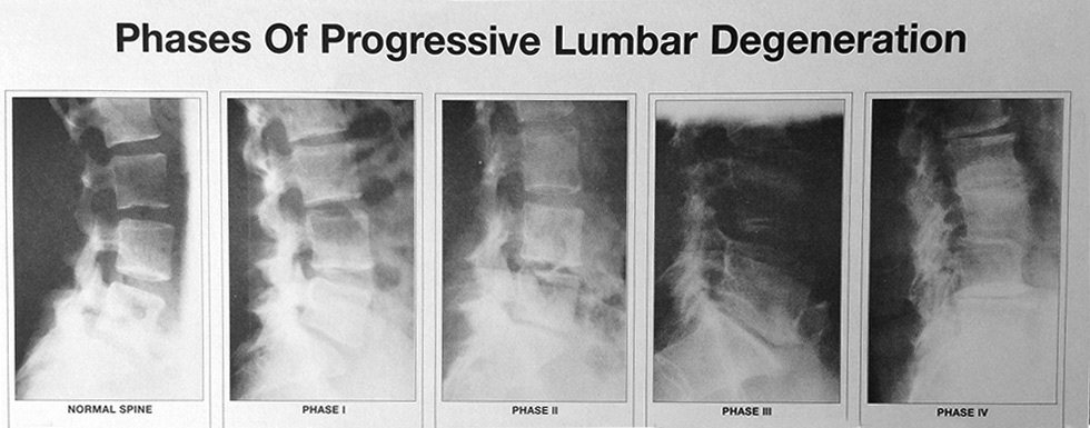 Phases of Lumbar Degenaration