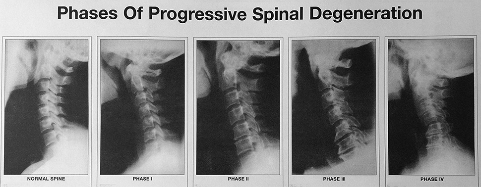 Phases of Spinal Degeneration